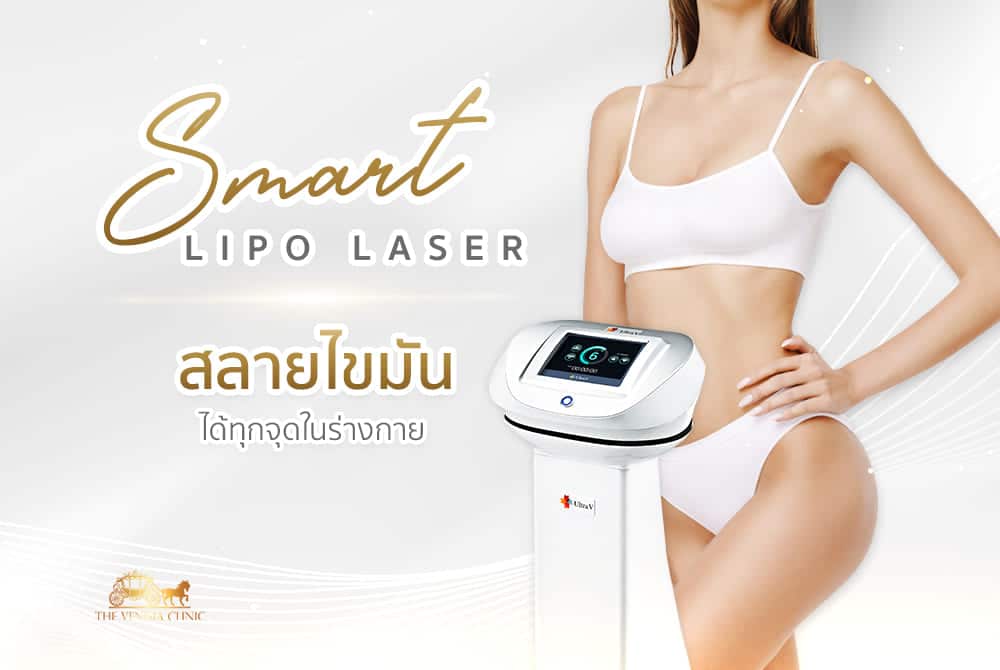 smart lipo laser